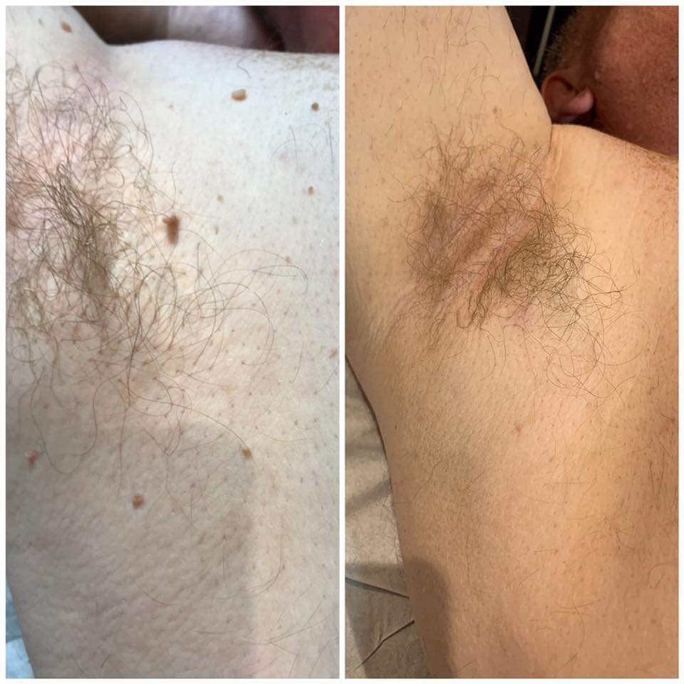 Skin tag removal before and after result — Shell Davis